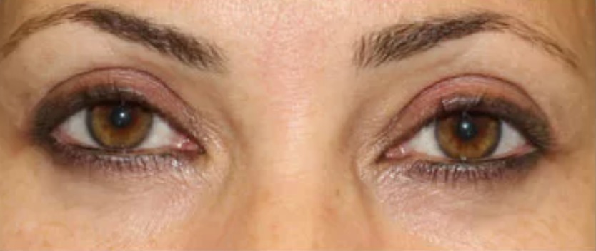 After Eyes - Front View
